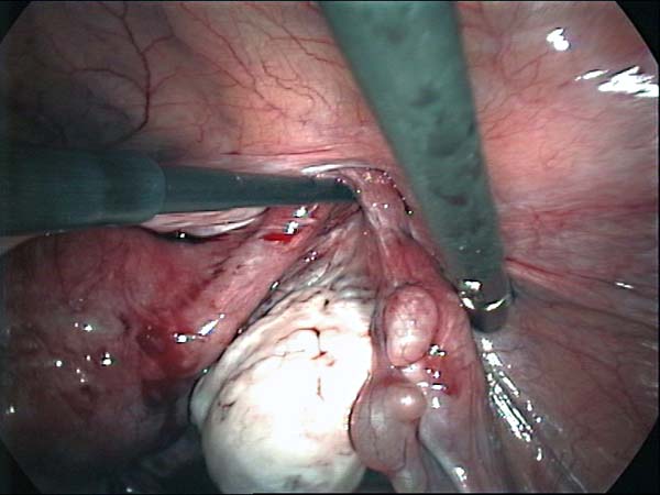 dissecting tubo ovarian adhesions