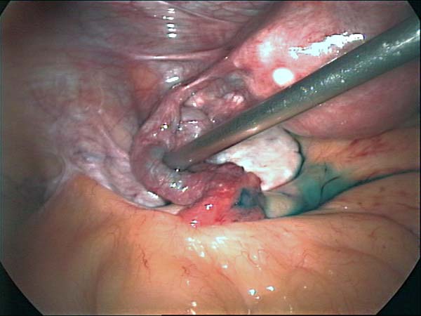 dye flowing in the fallopian tube