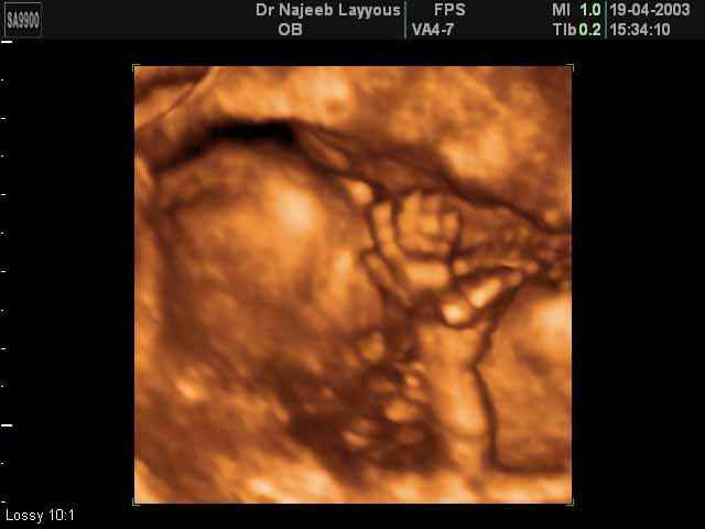 Main Foetale 14 semaines