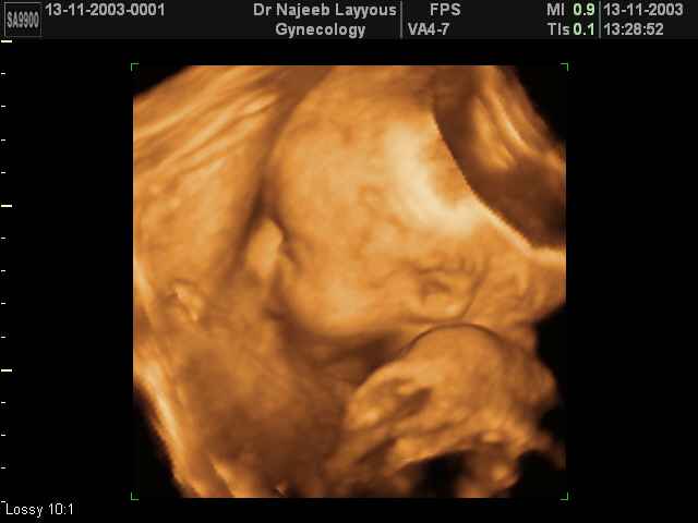 profile du fœtus