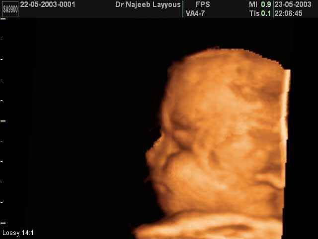 fetal profile