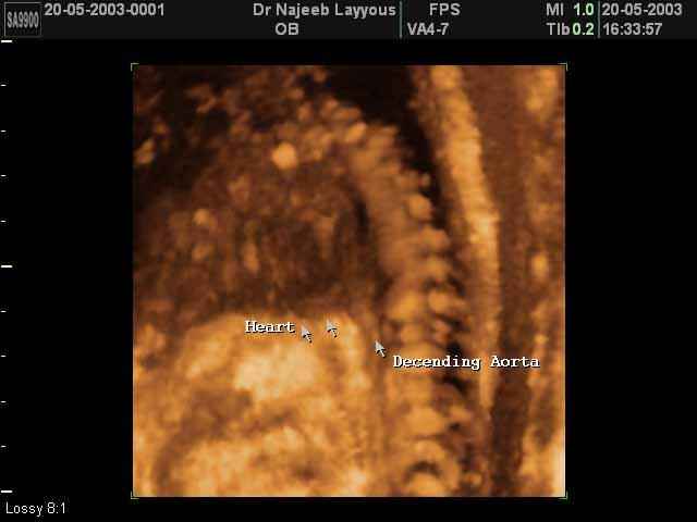 Coeur Foetal