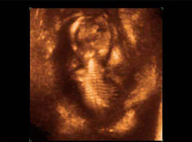 3D Photos échographie du squelette du fœtus
