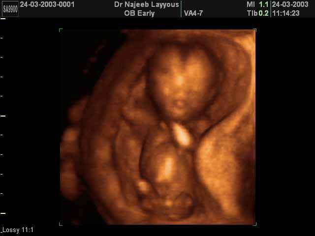صور للجنين في المراحل الأولى من الحمل