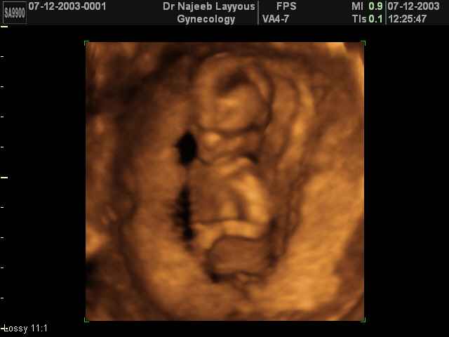 First Trimester Photos