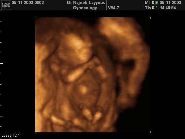 First Trimester Photos