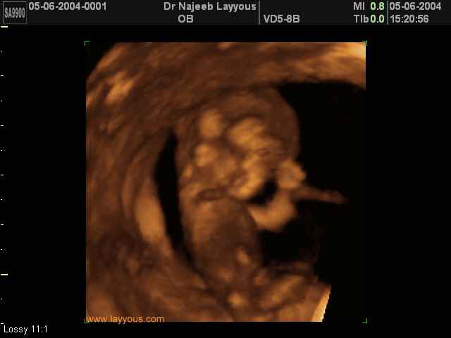 First Trimester Photos